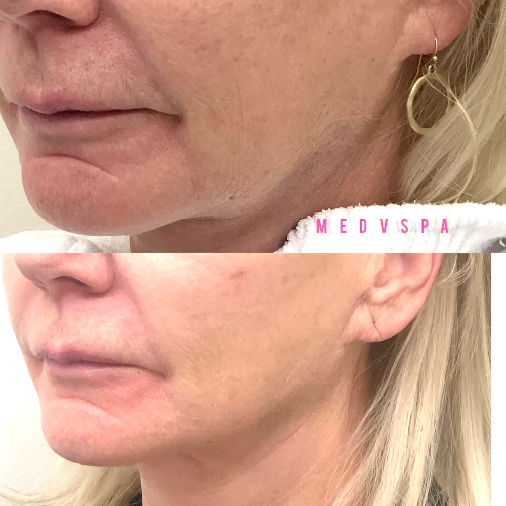 Juvederm Volux filler and SkinVive used with Botox for jawline definition