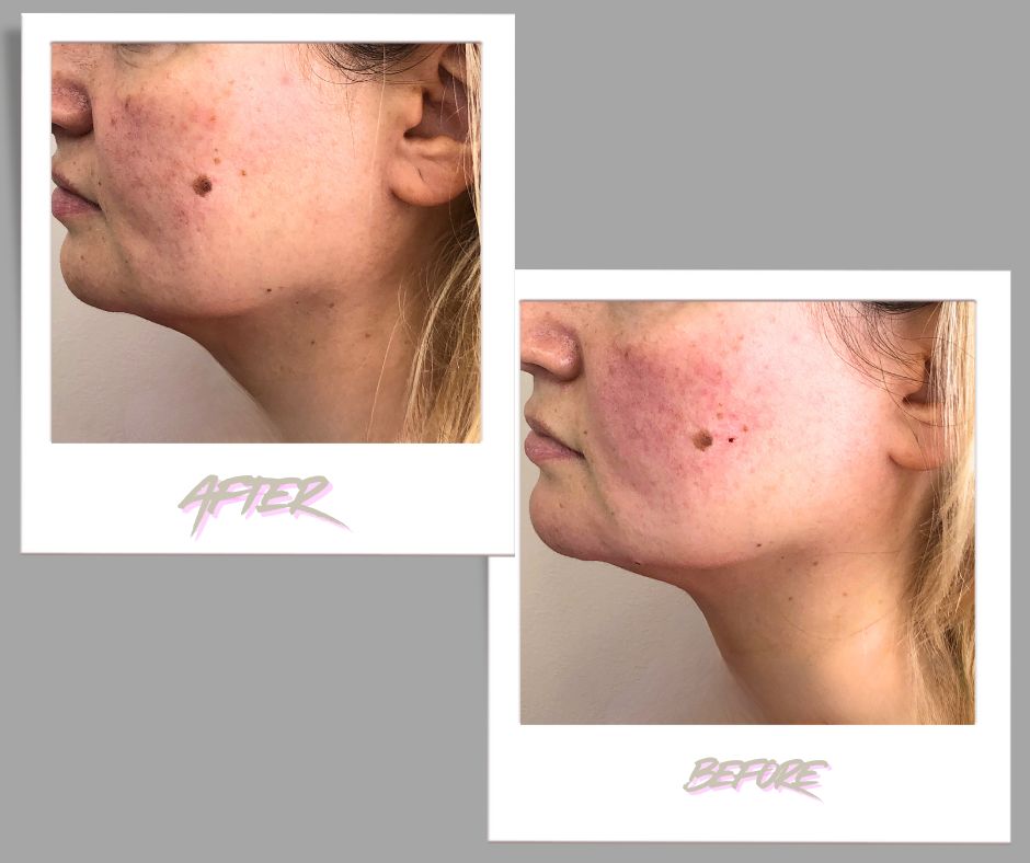 Masseter botox double chin before after Toronto