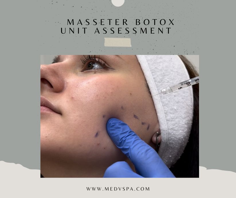 Masseter botox unit assessment left right difference Toronto