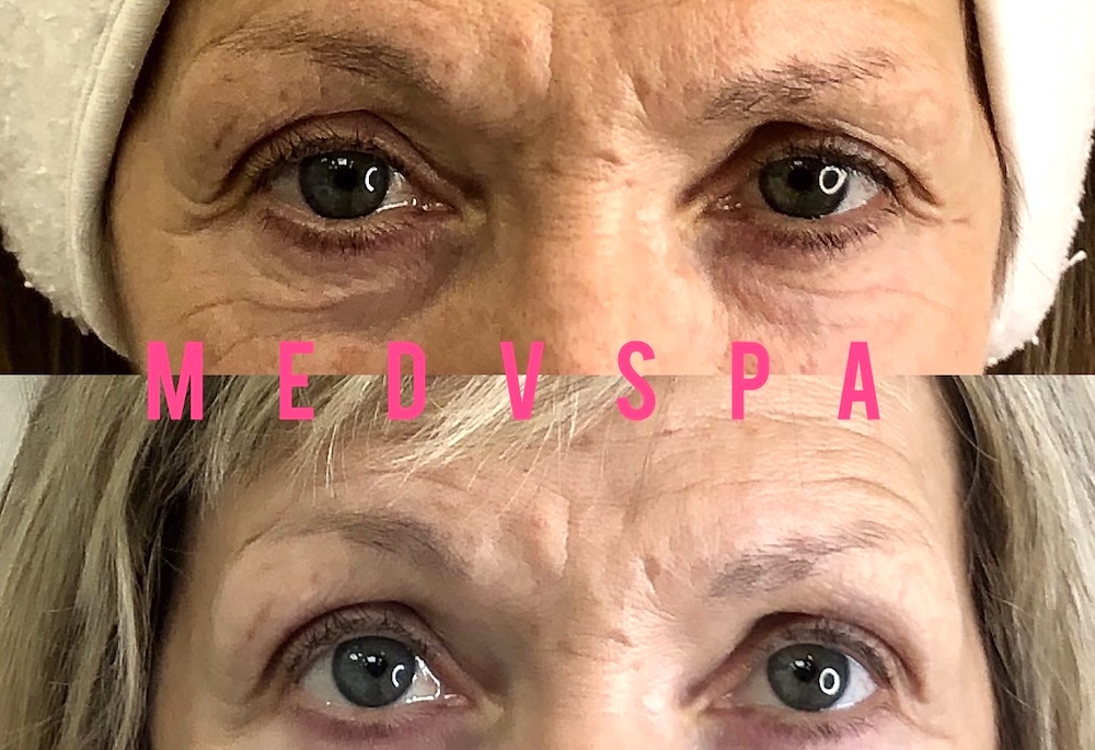 Botox Brow Lift treatment for peri- and menopausal women in Toronto