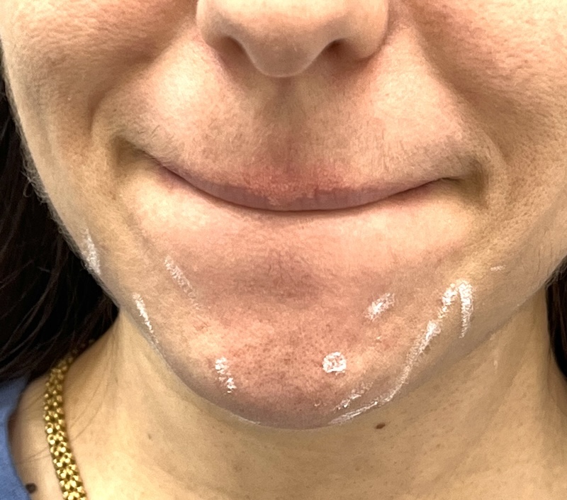 Young client with chin marks for  preventive Botox