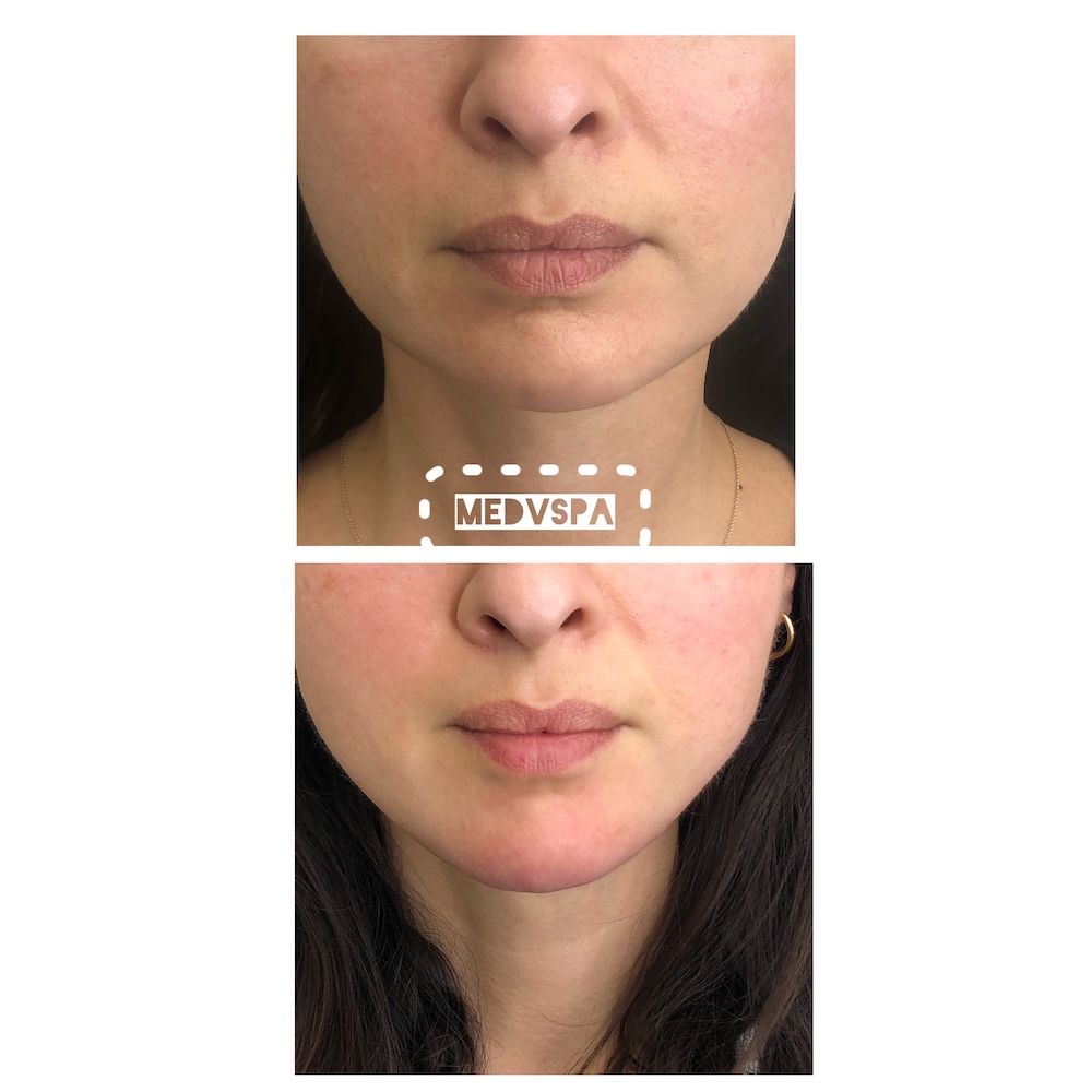 Before and after chin filler results at MedVSPA Toronto