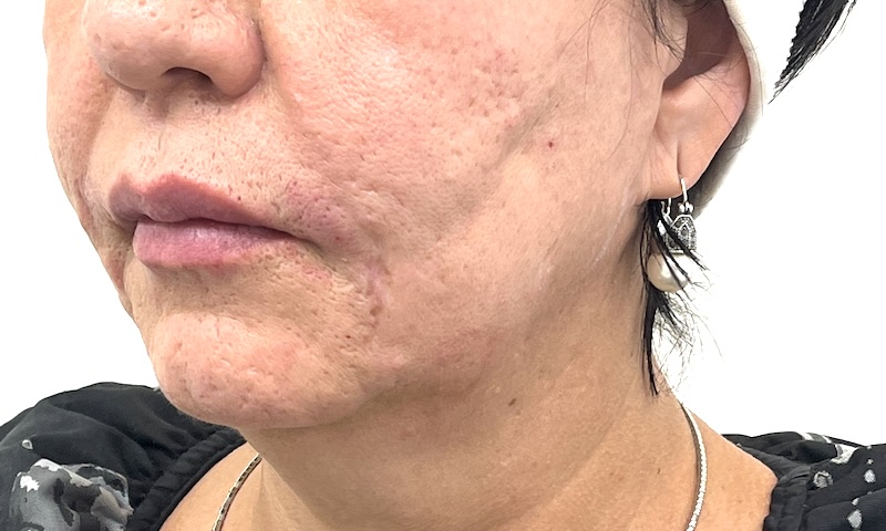 Photo showing how the area looks after chin filler  for aftercare steps in Toronto