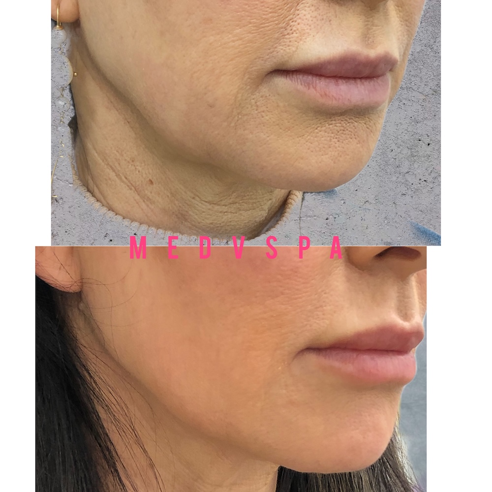 Before and after non-surgical chin filler treatment in Toronto at MedVSPA clinic
