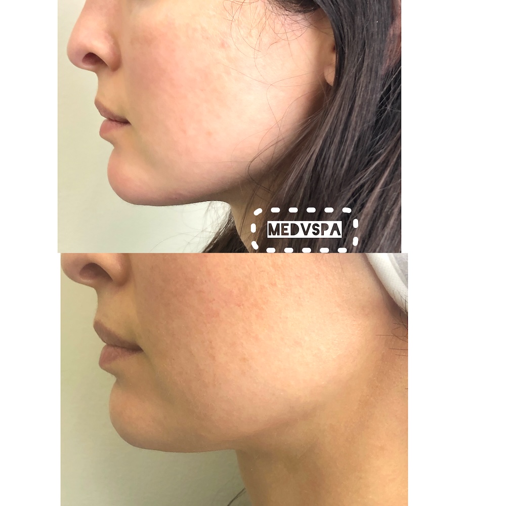 Profile comparison showing increased chin projection after filler in Toronto