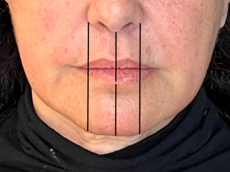 Before and after chin filler in Toronto showing restored chin width and symmetry