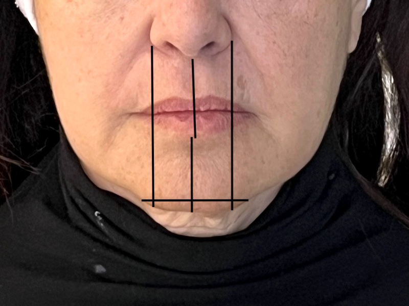 Diagram showing balanced nose, lip, and chin proportions for chin filler evaluation in Toronto