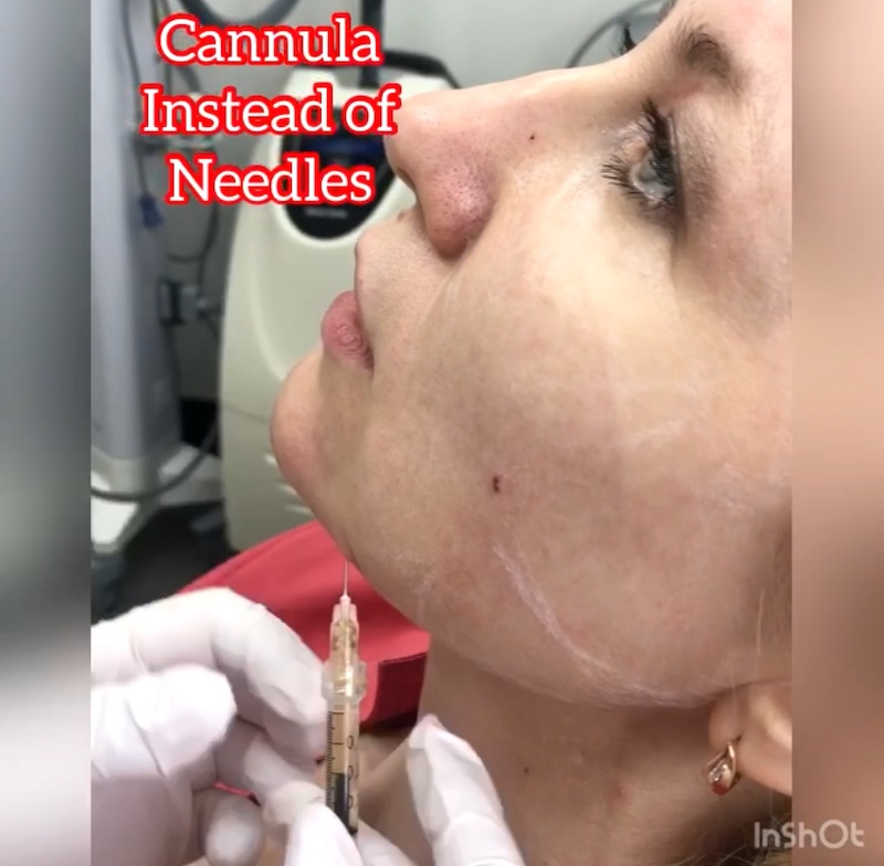 Experienced MedVSPA team in Toronto specializing in chin fillers