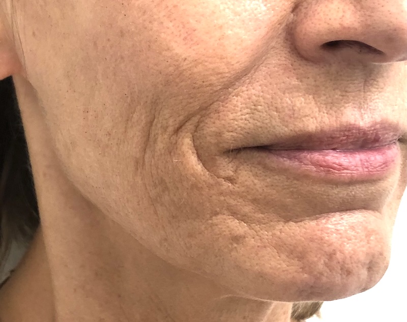 Photo showing how menopause affects the bone and muscle around the chin