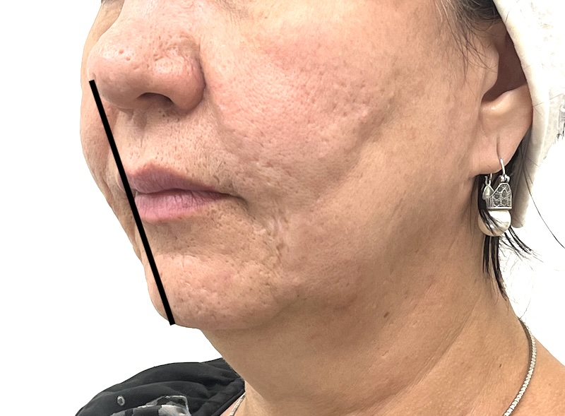 Profile showing chin alignment with Ricketts’ line in Toronto chin filler evaluation