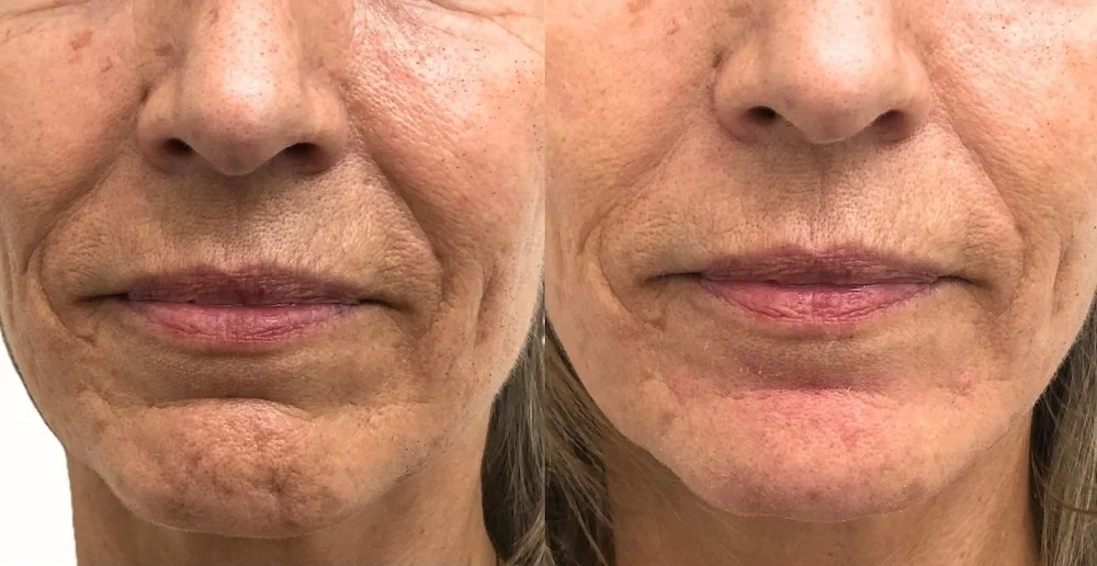 Chin filler before and after showing improved chin shape and lower-face proportions