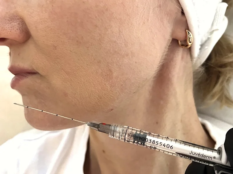Chin filler treatment using a cannula at MedVSPA Toronto