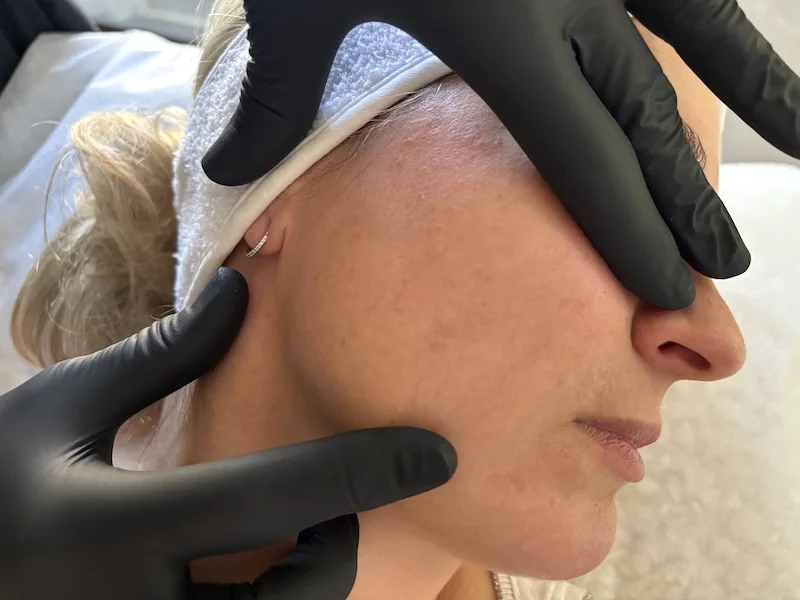 Dermal filler assessment for a mature face at MedVSPA Toronto