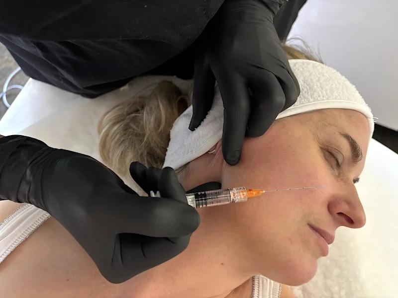 Jawline filler treatment using a cannula at MedVSPA Toronto