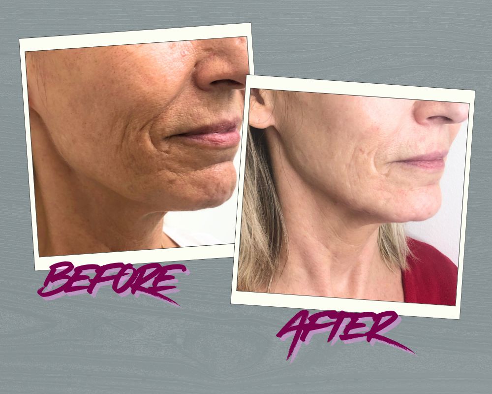 Subtle yet visible lift — see real jawline filler before and after results.