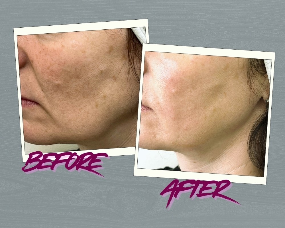 Natural jawline filler  Juvederm Voluma contouring results Toronto