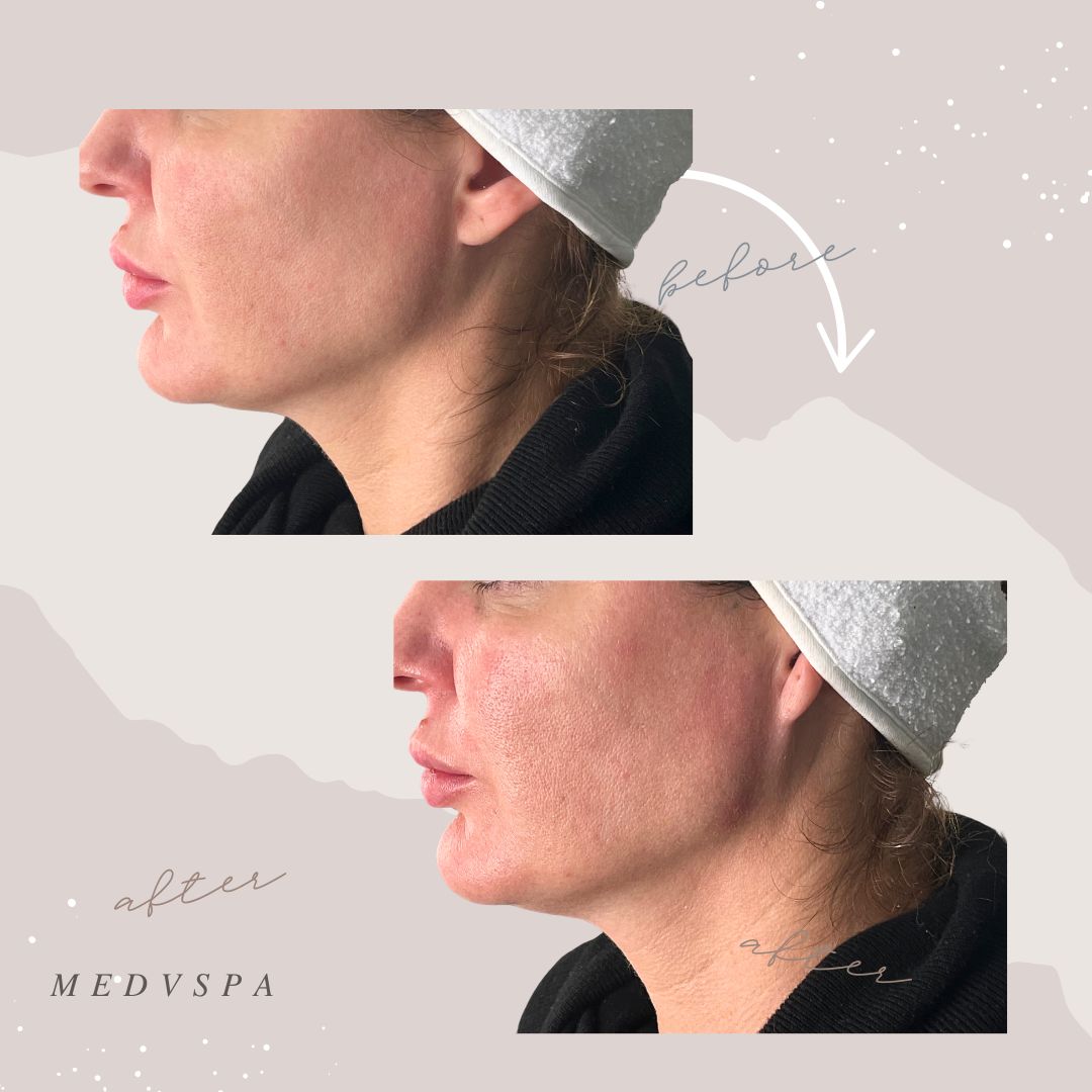 Natural result after Volux, Voluma jawline filler injections.