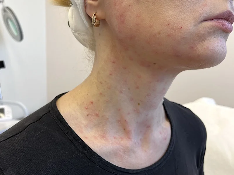 SkinVive treatment on the face and neck at MedVSPA Toronto