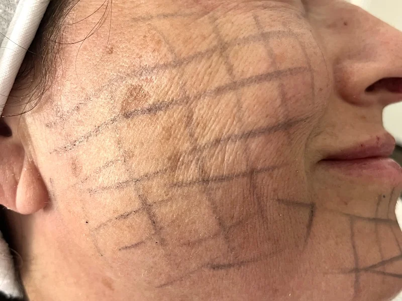 SkinVive facial treatment planning at MedVSPA Toronto