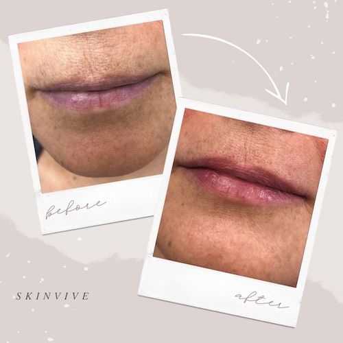 Dermal fillers Toronto smoker lines before and after