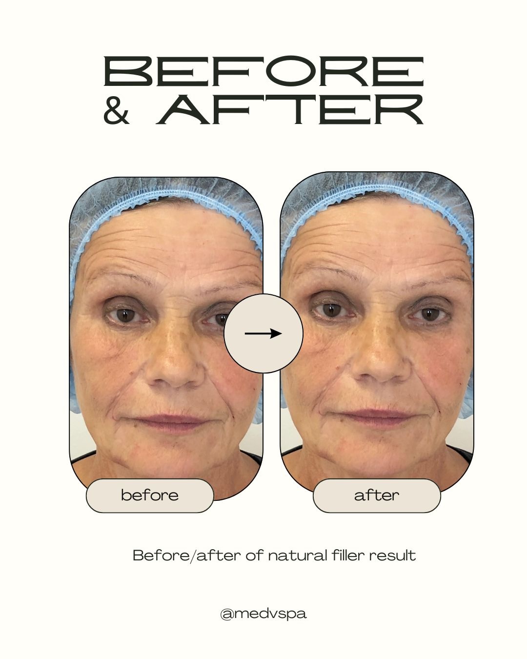 Dermal filler Toronto results