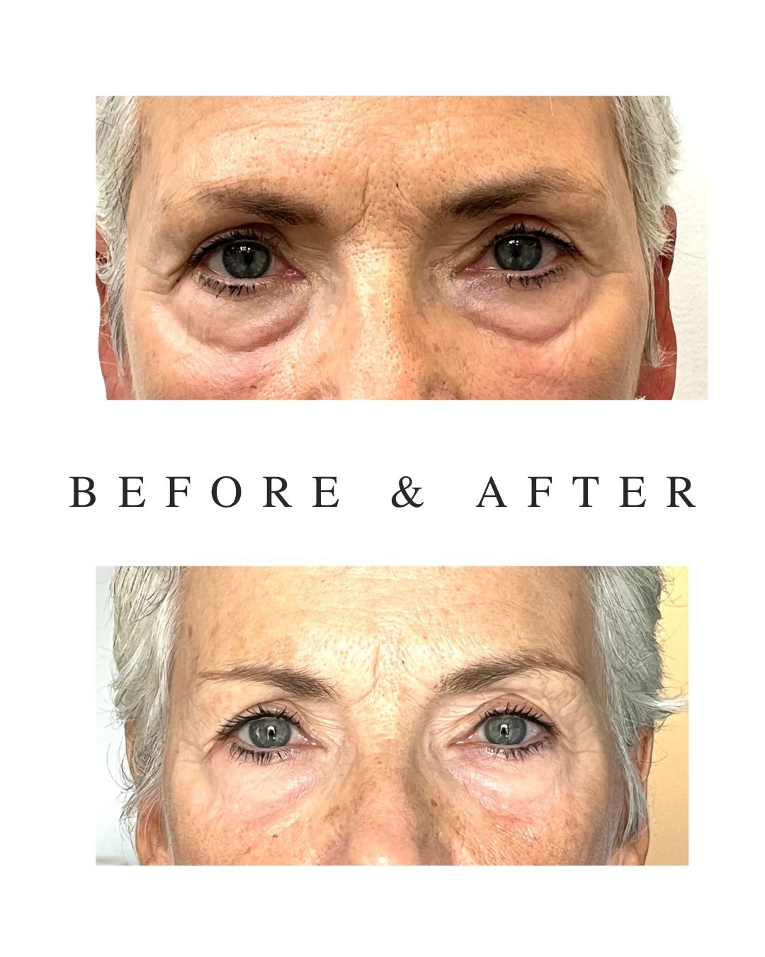 Before and after tear trough filler in mature client showing natural rejuvenation in Toronto