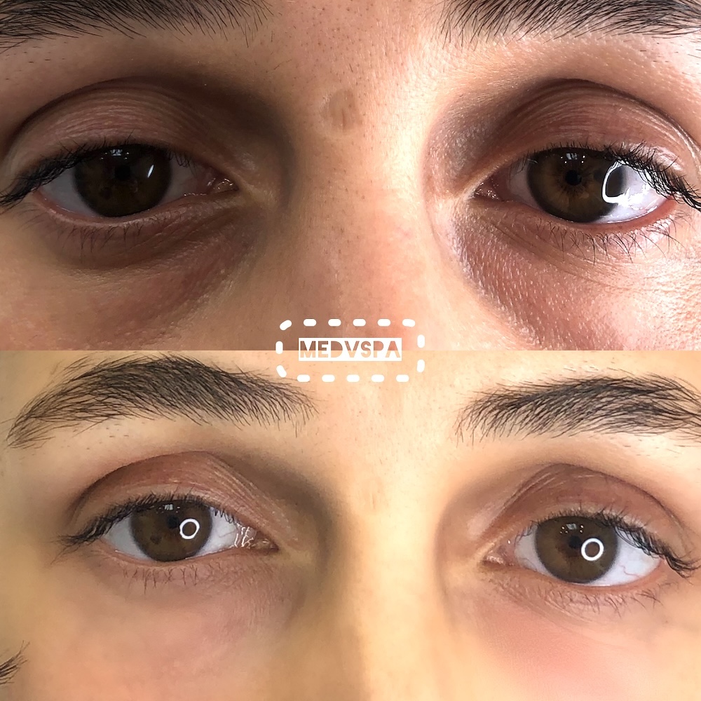 Before and after of dark circles treated with filler in Toronto
