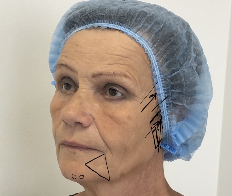 Dermal fillers supporting facial structure and volume restoration