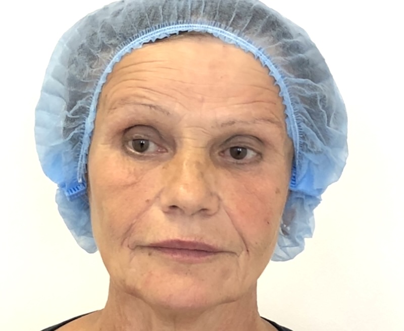 Dermal fillers restoring facial balance in mature skin