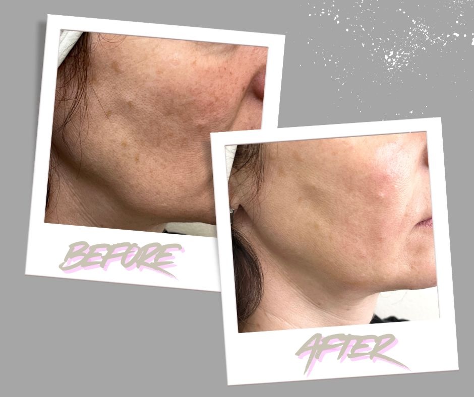 SkinVive by Juvederm Toronto – personalized treatments at MedVSPA MedVSPA Toronto results of SkinVive for natural, glowing skin