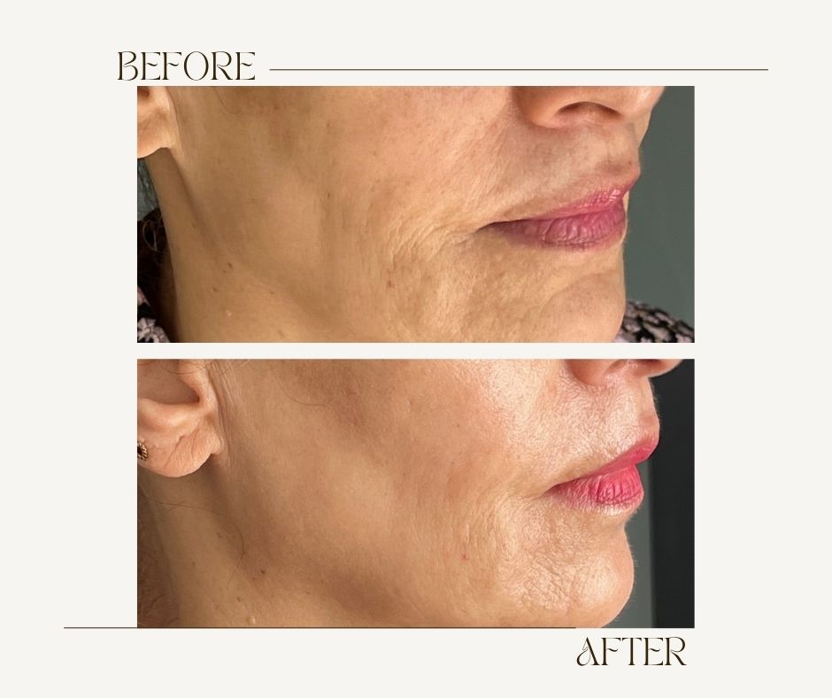 Before and after SkinVive by Juvederm Toronto results Before and after SkinVive results at MedVSPA Toronto showing smoother, hydrated, youthful skin