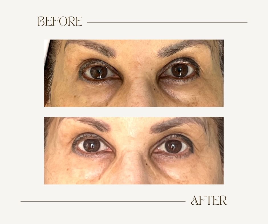 Before and after SkinVive results for eyes Toronto Before and after SkinVive at MedVSPA Toronto showing brighter under-eyes