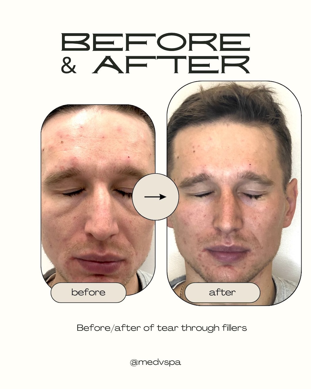 Before and after under-eye filler in Toronto showing reduced hollows and dark circles