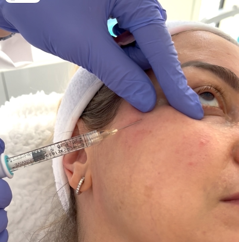 Close-up of cannula technique for under-eye filler injection at MedVSPA Toronto