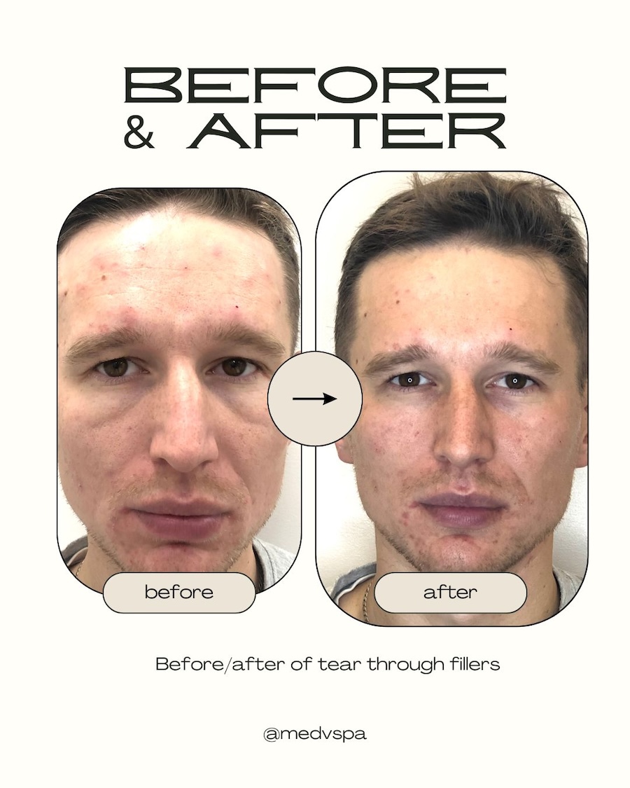 Tear trough filler before and after in Toronto showing under-eye rejuvenation results