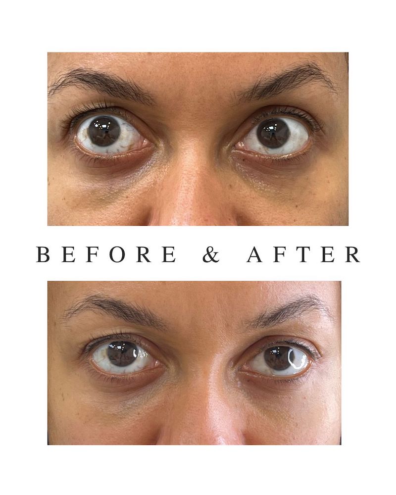 before and after tear trough hyaluronic acid filler Toronto