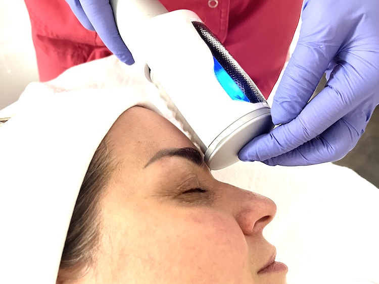  Client receiving Endosphères facial for hooded eyelids