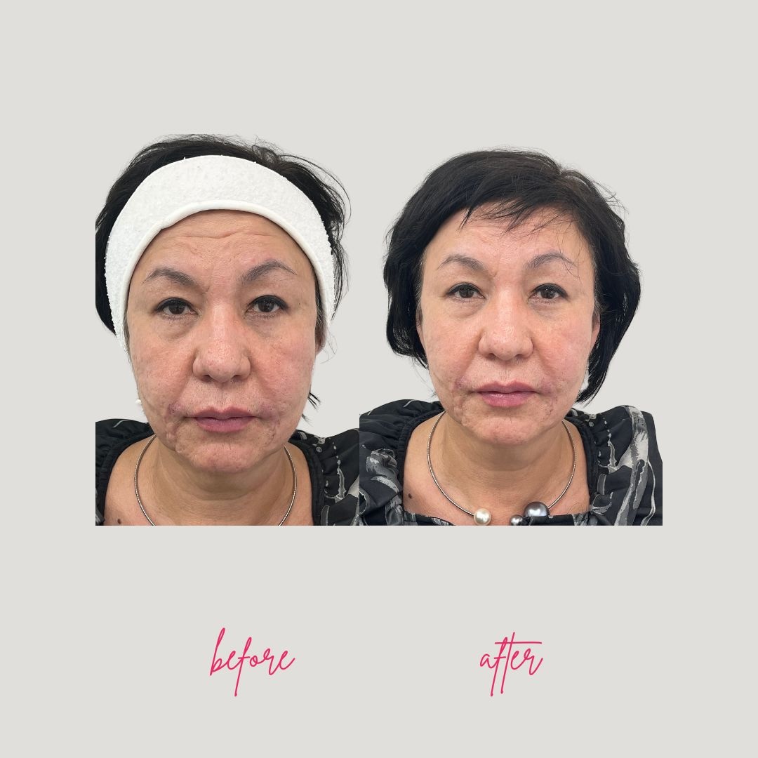 Facial lift and contour improvement before and after endospheres treatment