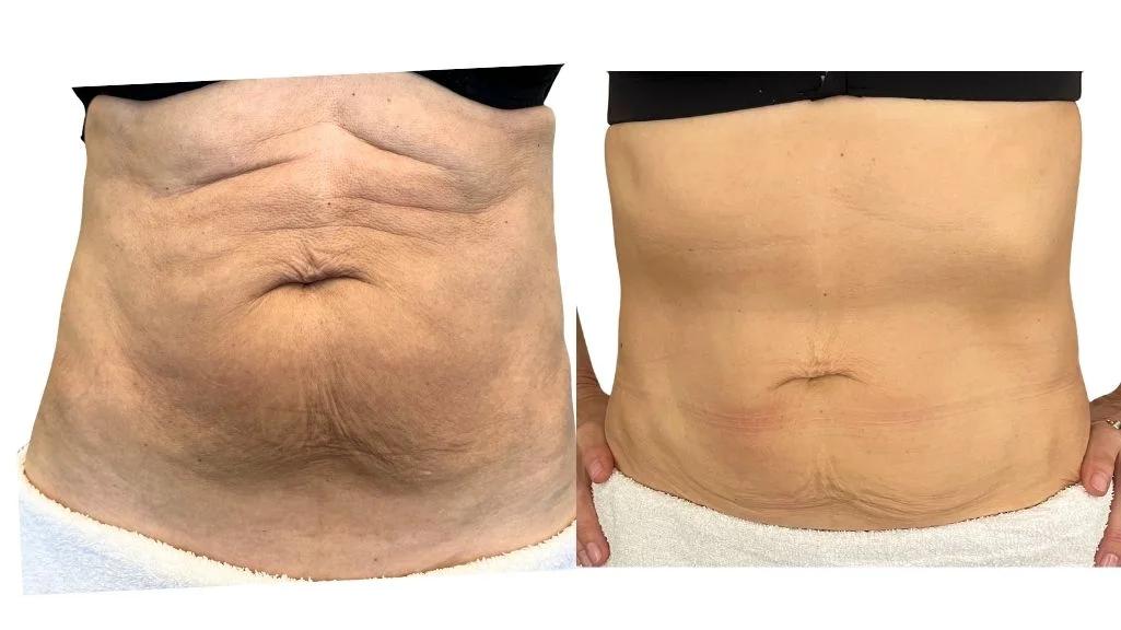 Endospheres Therapy abdomen before after Toronto body shaping
