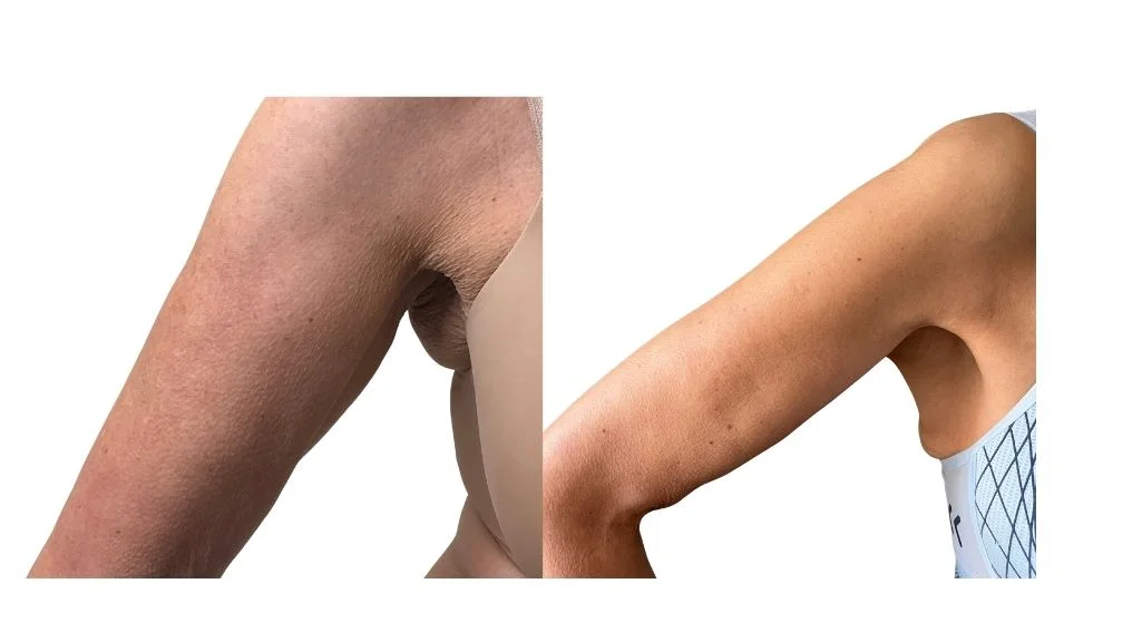 Endospheres Therapy arms skin tightening before after Toronto