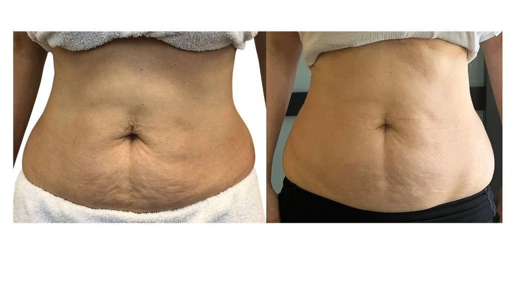 Endospheres Therapy body contouring abdomen Toronto smoother skin