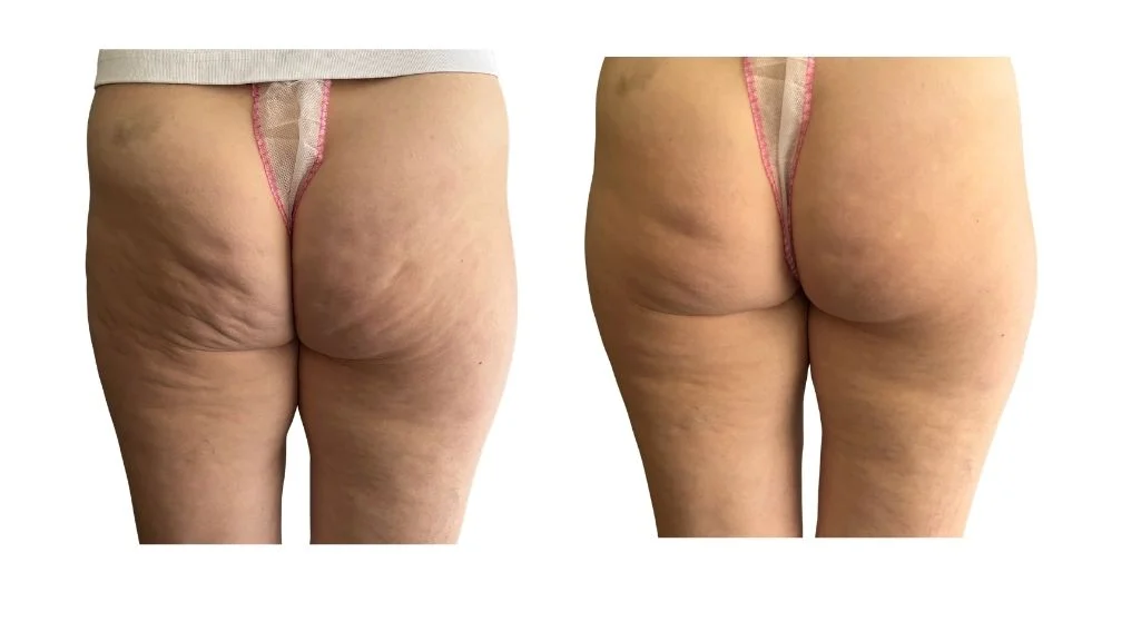 Endospheres Therapy cellulite thighs before after Toronto results