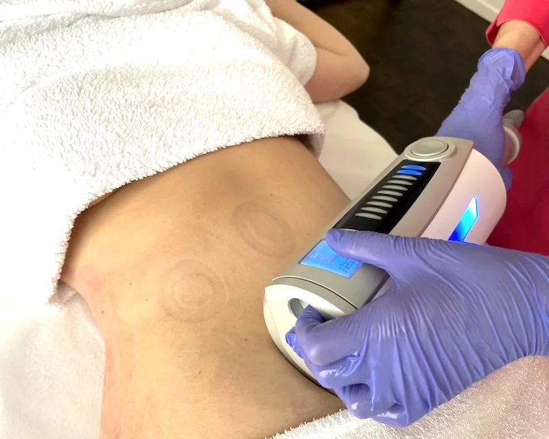 Comparison of Endospheres therapy and lymphatic drainage for swelling and tissue preparation