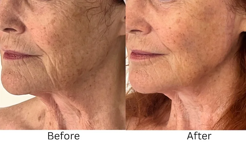 harmonyca before after jawline changes