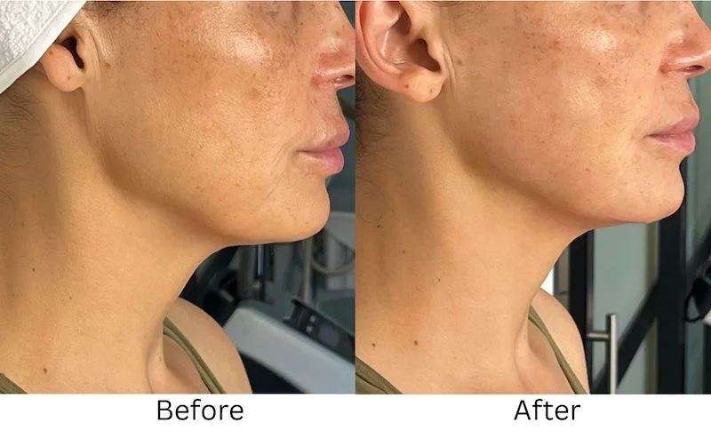 harmonyca-jawline-before-after
