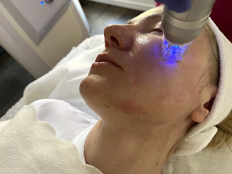 RF microneedling treatment combined with a HArmonyCa treatment plan