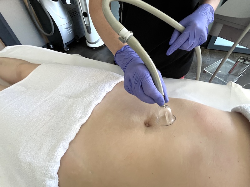 Lymphatic drainage massage for cellulite in Toronto