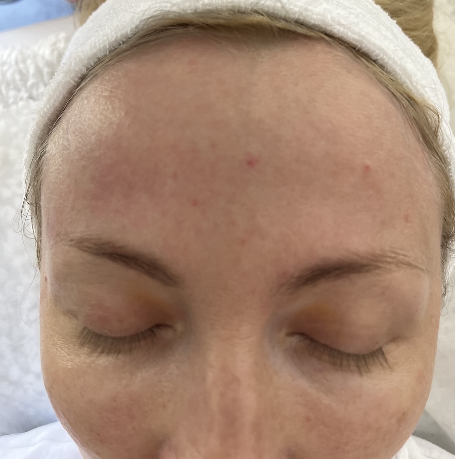 Before and after Sylfirm X RF Microneedling results  for hooded eyes at MedVSPA Toronto