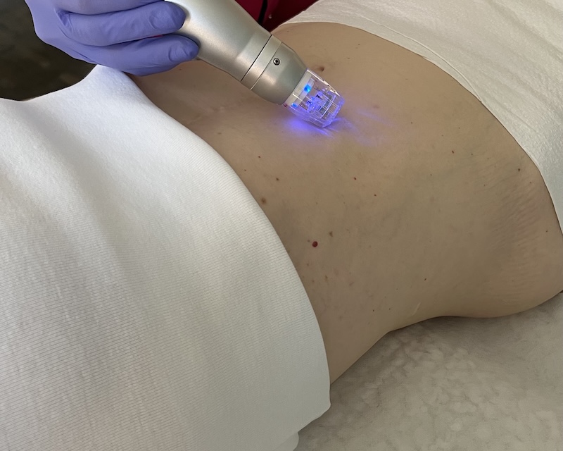 Practitioner performing RF Microneedling on client’s abdomen in Toronto