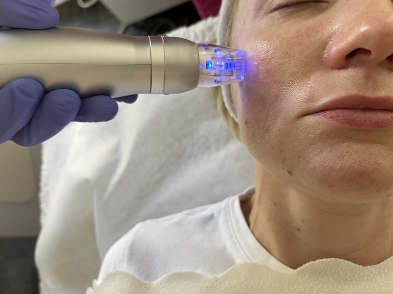 Sylfirm X RF Microneedling device close-up at MedVSPA Toronto